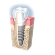 Имплантация зубов. Швейцарские импланты. 16 + 16 т.р. фото