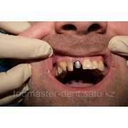 Восстановление зубов под протезирование фото