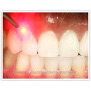 Лечение зубов без боли,без бора,без АНЕСТЕЗИИ! фото