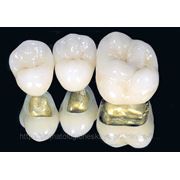 Зуб из металлокерамики фотография