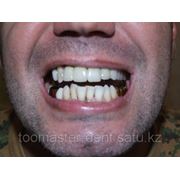 Несъемное протезирование зубов фото