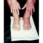 Псориатическая ониходистрофия (поражение ногтей)