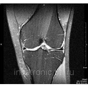 МРТ диагностика коленный сустав