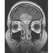 МРТ диагностика Глазные орбиты и зрительный нерв