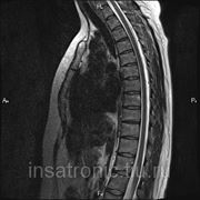 МРТ диагностика грудной отдел позвоночника