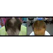 Клиника по пересадке волос в России