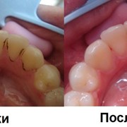 Профессиональная чистка зубов в Алматы фотография
