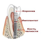 Зубной имплант фотография