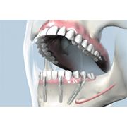 Зубные протезы несъемные