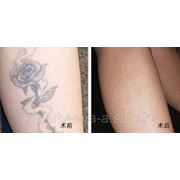 Лазерное удаление татуажа фотография