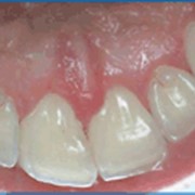 Профессиональная гигиена полости рта (профессиональная чистка зубов) фото