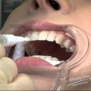 Лечение кариеса, некариозных поражений зубов фото