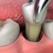 Удаление зуба фотография