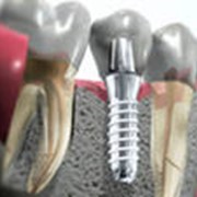 Имплантация зубов в Алматы