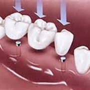 Восстановление корней зубов