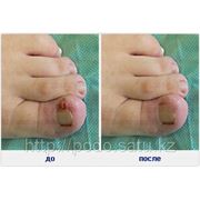 Нехирургическое удаление вросшего ногтя фото