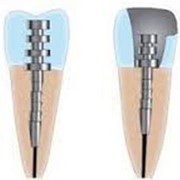 Восстановление зубов (анкерный штифт)