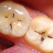 Лечение заболеваний зубов фотография