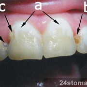 Отбеливание зубов химическое