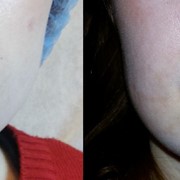 Коррекция спинки носа +увеличение губ фотография