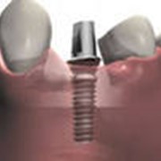 Установка протеза на зубные импланты фото