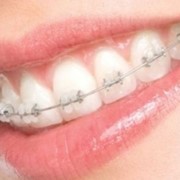 Выравнивание зубного ряда