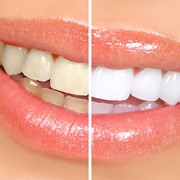 Отбеливание зубов системой Beyond Whitening Accelerator