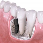 Несъемное эстетическое протезирование зубов