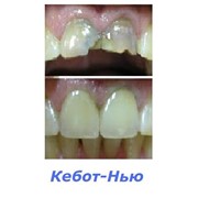 Лечение, протезирование зубов металлокерамическими коронками фото