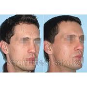 Эндопротезирование лица и изготовление контурных эндопротезов лица фото