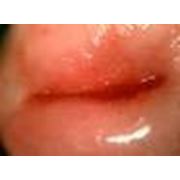 Цифровая видеокольпоскопия фото