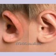 Коррекция формы ушных раковин (Отопластика) фото