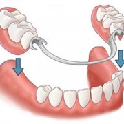 Частичный съемный пластмассовый протез (до 6 зубов)