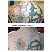 Лазерное удаление тату и татуажа фото