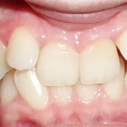 Ортодонтическое лечение фотография