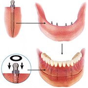 Мини-импланты по американской технологии, Стоматологические услуги, Ортопедическая стоматология фото