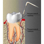 Лечение пародонтита