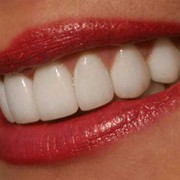 Косметическая реставрация зуба фотополимером фото