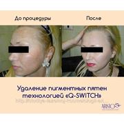 Лазерное удаление пигментных пятен фото