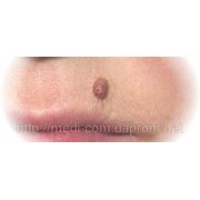 Удаление родинок на теле. Дерматоскопия фото