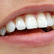 Ортодонтия, выравнивание зубов