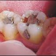 Лечение пульпита фото