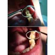 Лечение кариеса зубов. фотография