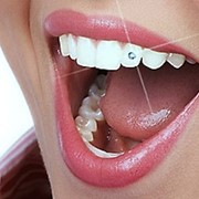 Установка стразов на зубы