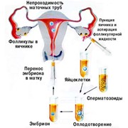 Экстракорпоральное оплодотворение IVF фотография
