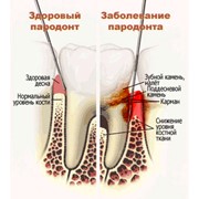 Лечение кариеса, некариозных поражений зуба фотография