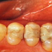 Микропротезирование зубов