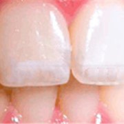 Восстановление эмали, фторирование зубов фото