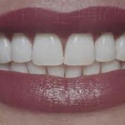 Косметическое восстановление зубов. Стоматологический кабинет ТРИО фото