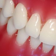 Реставрации фронтальных зубов